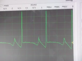 EKG 4.webp