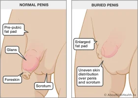 Buried_penis_MED_ILL_EN.webp