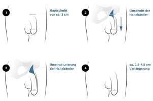 penisverlaengerung-muenchen-pd-dr-med-maximilian-eder.webp
