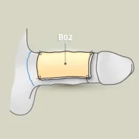 ill_m_penis_penisverdickung_Haut-Fett-Manschette_04.webp