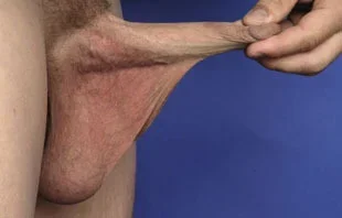 pimple.webp