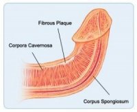 peyronies-disease.jpg