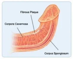 peyronies-disease.webp