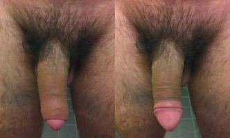 Flaccid_uncut_penis_with_foreskin.webp